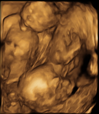 3d ultrasound pictures of twins. Ultrasound photobook